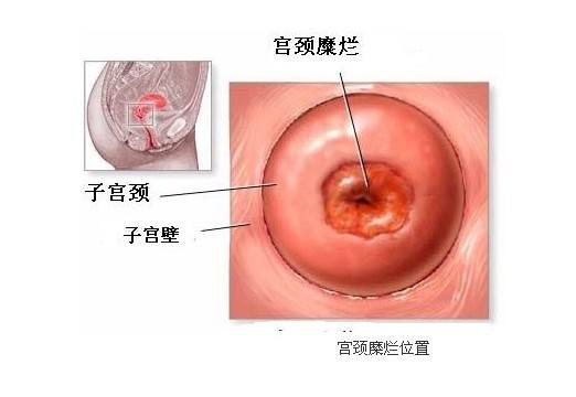 宫颈糜烂有什么症状？该怎么办？